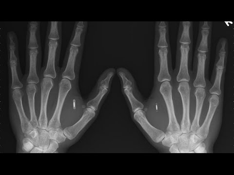 NEWS AND PROPHECY: MAN BECOMES HUMAN BITCOIN WALLET WITH IMPLANTED MICROCHIP